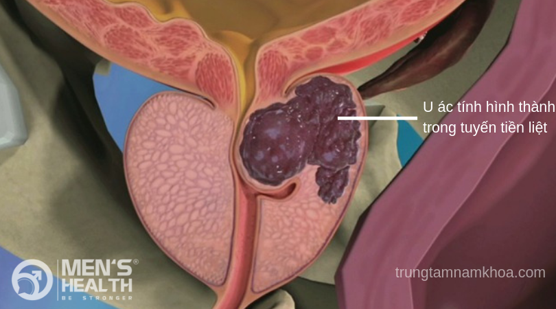 Giai đoạn đầu ung thư tiền liệt tuyến hầu như không có triệu chứng rõ ràng. Ung thư tiền liệt tuyến là loại u ác tính phát triển trong tuyến tiền liệt của nam giới.