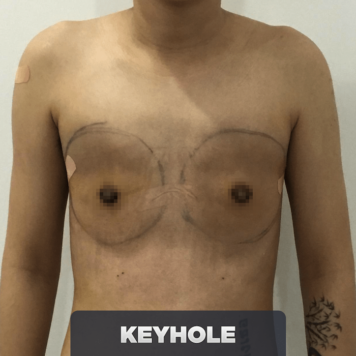 Dành cho các transman có mô tuyến vú nhỏ hoặc trung bình. Với phương pháp này, bác sỹ sẽ tiến hành rạch 1 đường nhỏ hình chữ U (keyhole) hoặc chữ O (Peri-areolar) dọc theo viền quầng vú. Sau đó tiến hành lấy toàn bộ phần mô & tuyến vú bằng đầu nội soi siêu nhỏ