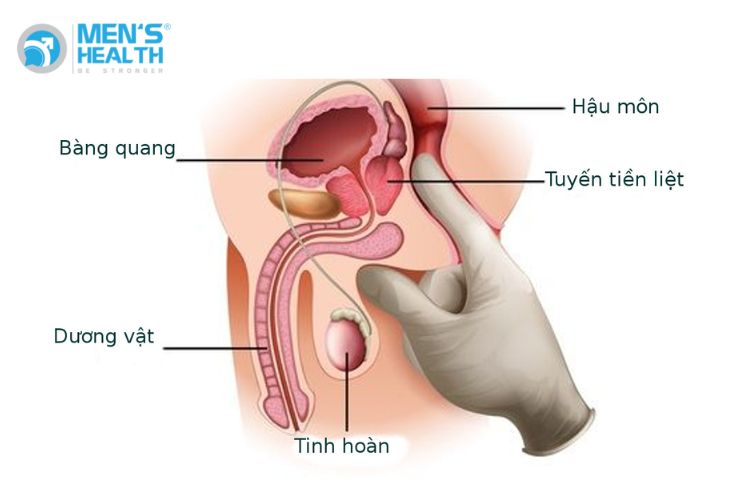 Tiền liệt tuyến là một cơ quan thuộc hệ sinh dục nam, nằm dưới bàng quang, cạnh túi tinh