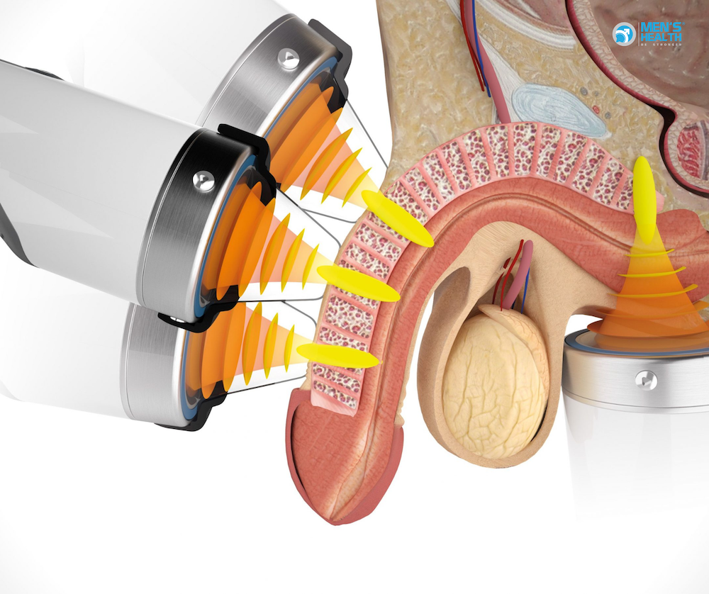 Shock Wave Therapy for Male Sexual Health Conditions at Men’s Health Center